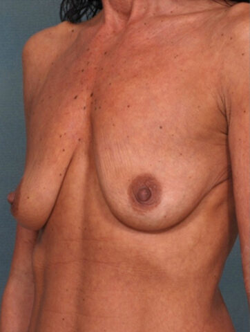 Case # 11 before photo