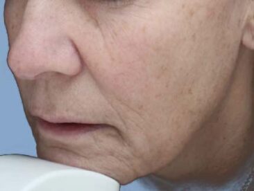 Case # 41 before photo