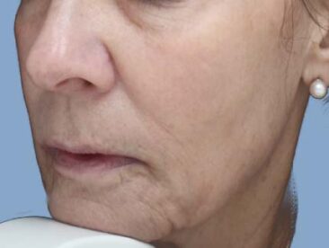 Case # 41 after photo