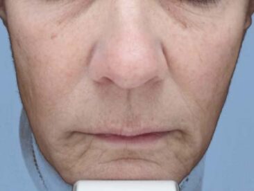 Case # 41 before photo