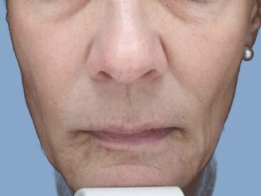 Case # 41 after photo