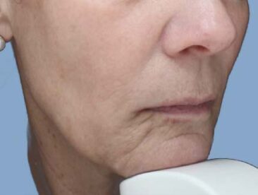 Case # 41 after photo