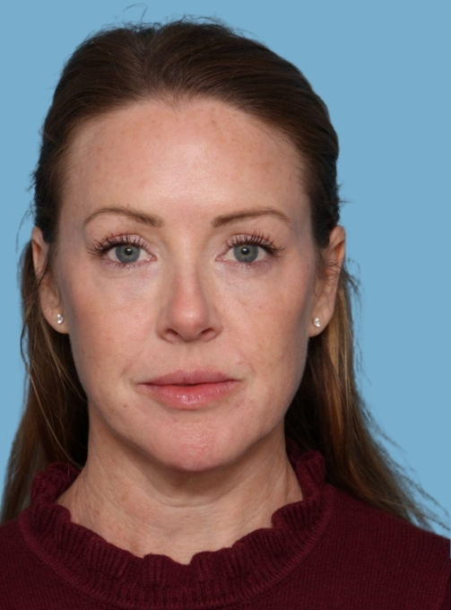 before and after gallery image