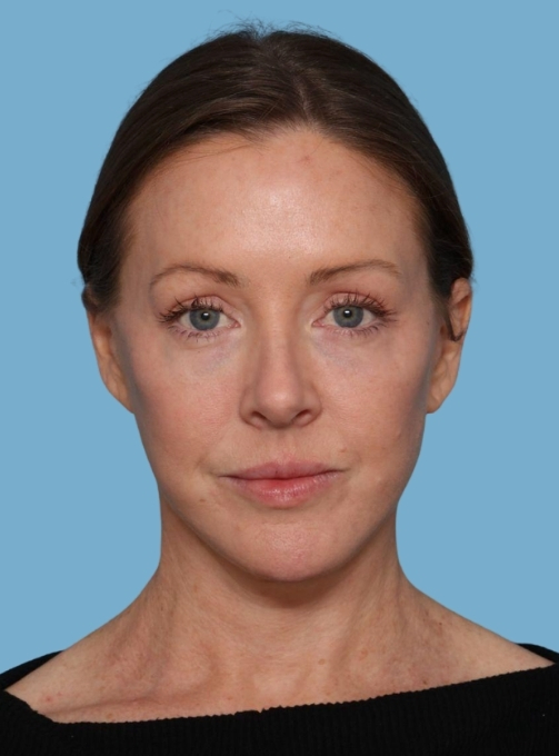 before and after gallery image