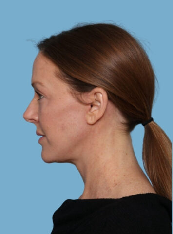 Case # 2 after photo