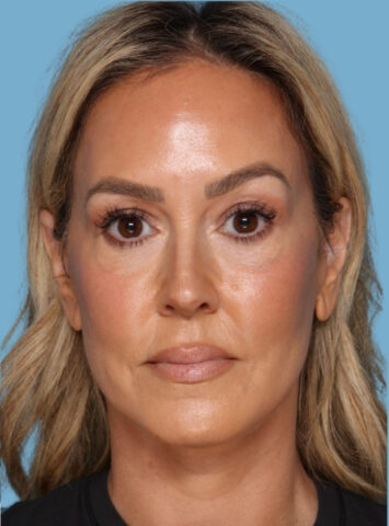 Case # 1 after photo