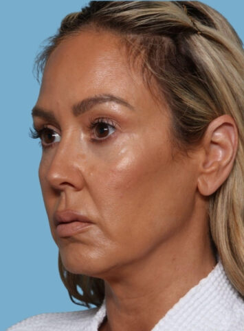 Case # 1 before photo