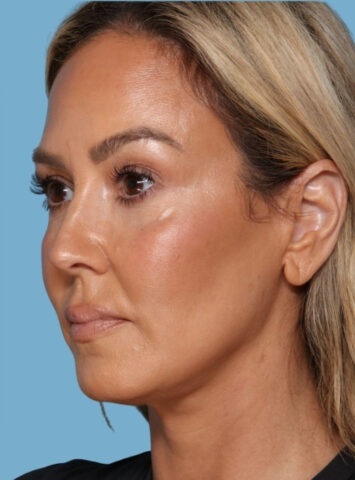 Case # 1 after photo