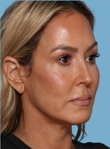 Case # 1 after photo